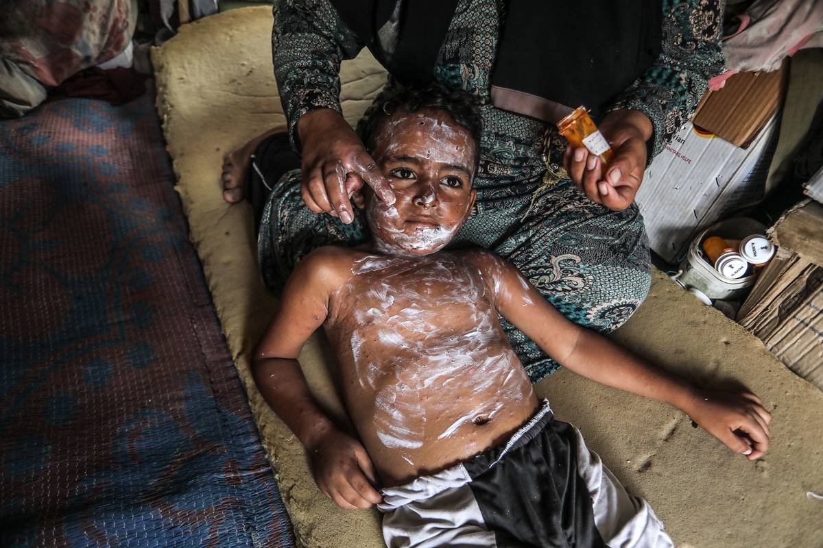 Gaza Chickenpox Outbreak: 9,300 Children Infected in Camps