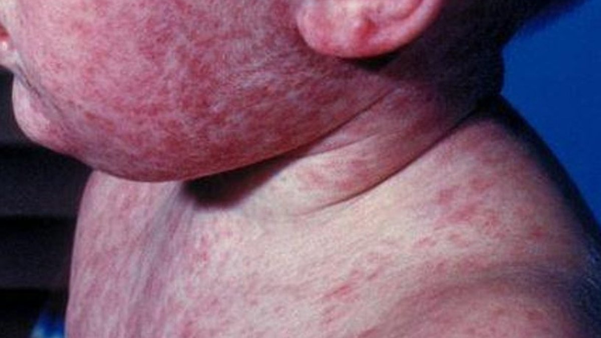 A CDC file photograph of a child with measles, illustrating the resurgence of the disease in the United States