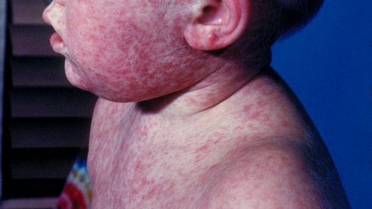 Pennsylvania reports first measles deaths in 35 years