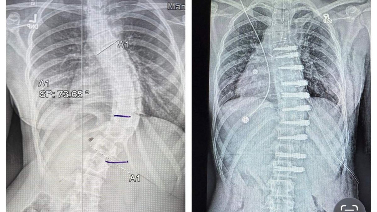 Before and after X-ray showing Vienna Pedatella’s scoliosis curve correction