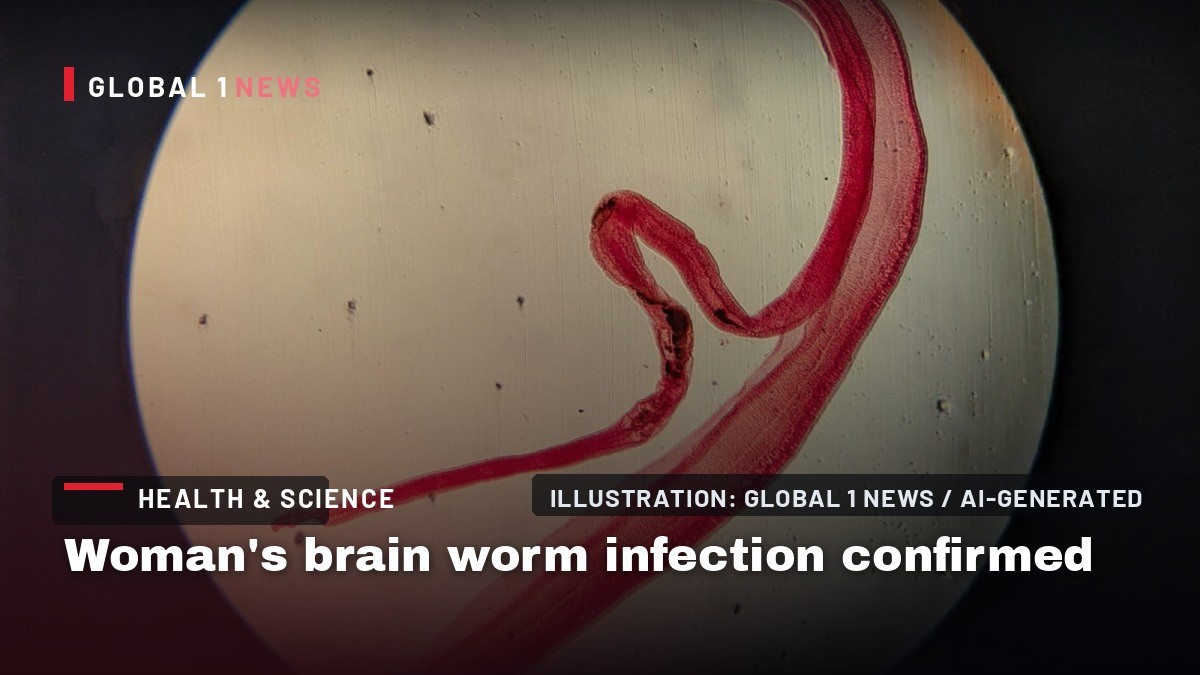 Woman's brain worm infection confirmed after eggs grow tails in lab test