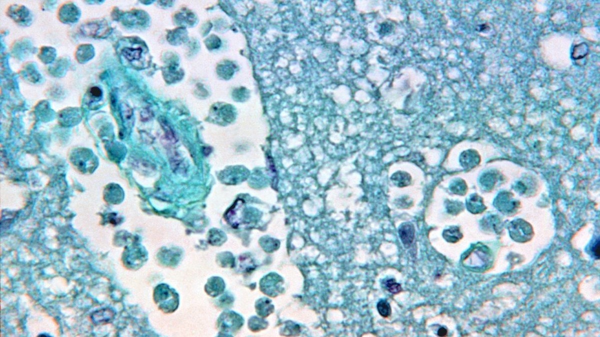 Magnified 500x, a photomicrograph of a brain tissue specimen showing the changes associated with a Naegleria fowleri amoebic infection. Photo: CDC