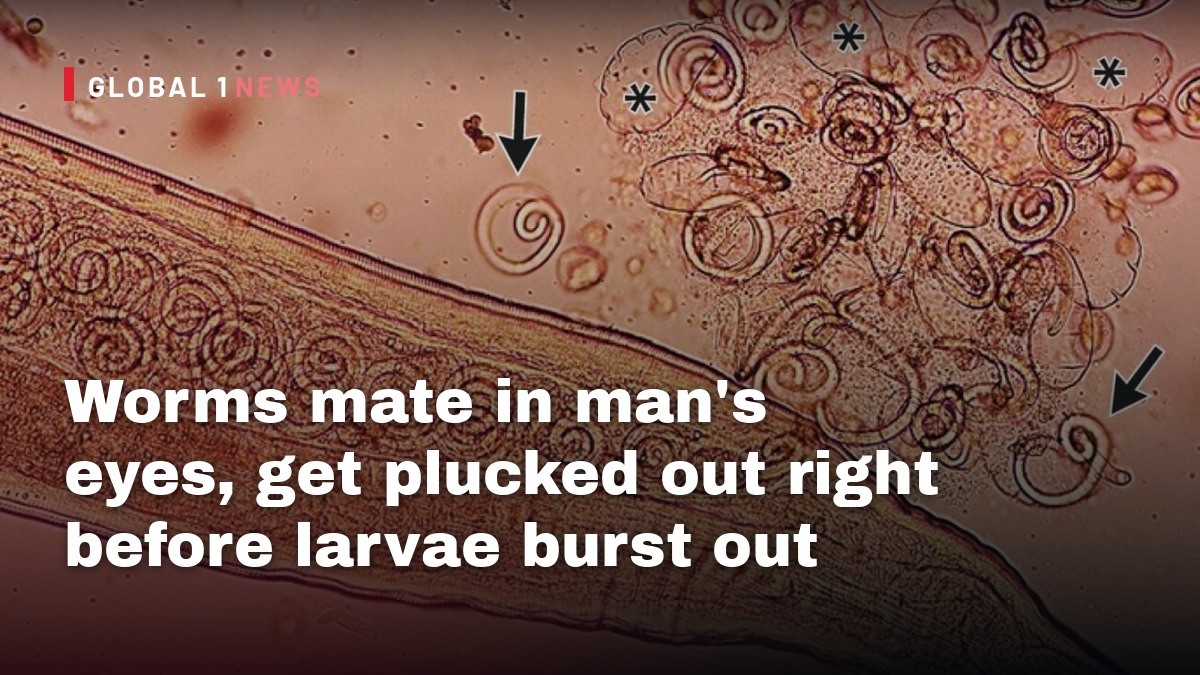 Worms mate in man's eyes, get plucked out right before larvae burst out